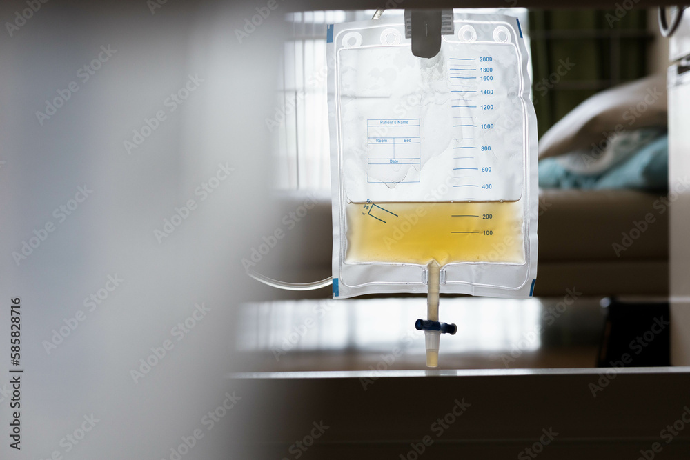 Urine bag, Wound and Ostomy ,Kidney Stone, an old patient have relaxing