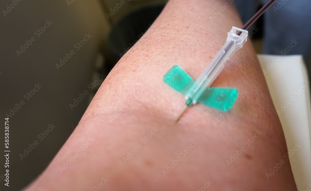 Foto de Medizinische Infusionsnadel zur Blutabnahme im Arm von Patientin in Arztpraxis do Stock
