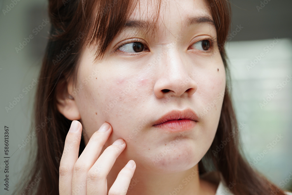 Acne pimple and scar on skin face, disorders of sebaceous glands, teenage girl skincare beauty problem. Acne pimple and scar on skin face, disorders of sebaceous glands, teenage girl skincare beauty problem.