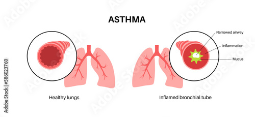 Asthma lung disease