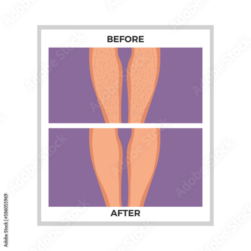Flat Hair Removal