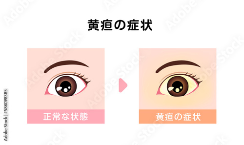 黄疸（おうだん) の眼球と健康な眼球の比較イラスト