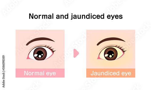 Comparison illustration of normal and jaundiced eyes