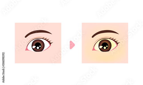 Comparison illustration of normal and jaundiced eyes