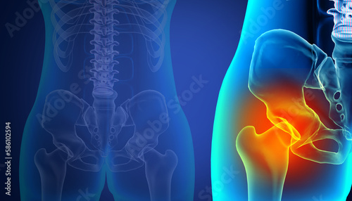 An overview of hip pain, one side pain, conditions, causes and treatment. 3d illustration