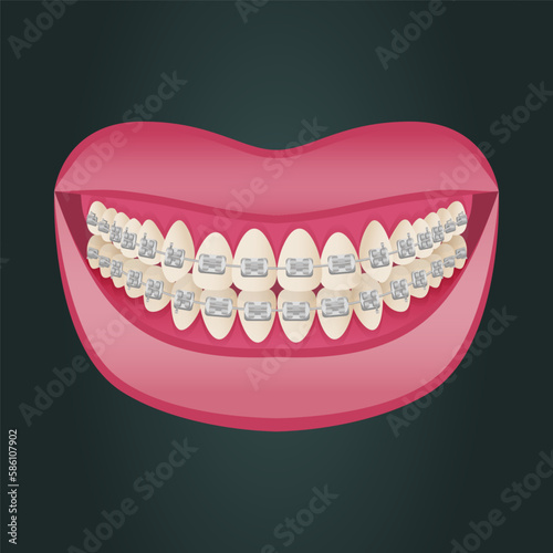 The concept of teeth alignment with braces. Orthodontic dentistry. The alignment of the teeth. Beautiful white teeth. Isolated flat vector illustration. Simple teeth in a row. Orthodontic treatment.