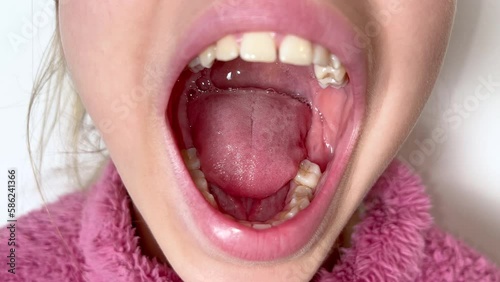 Child girl or teenage girl of eleven years old opens the mouth wide and shows the teeth, gums and throat the doctor. Concept of orthodontics, dental health, braces, otolaryngologist. photo