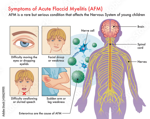 Medical illustration of Symptoms of Acute Flaccid Myelitis (AFM), with annotations.