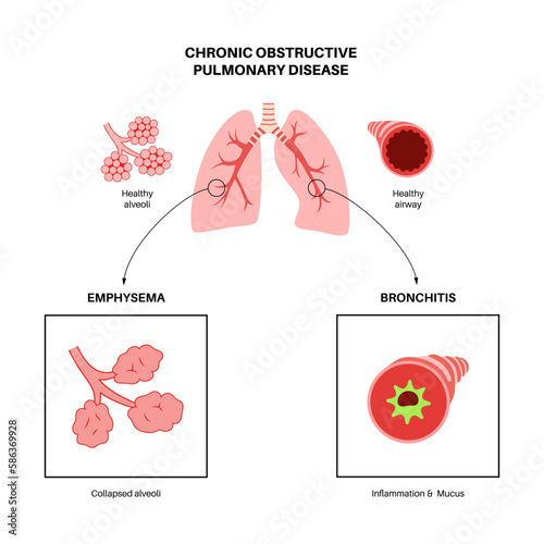 Chronic obstructive pulmonary disease