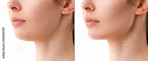 Close-up portrait of a woman before and after a chin correction procedure with neck liposuction. Fillers on the cheekbones and chin. The result of the procedure in a plastic surgery clinic.