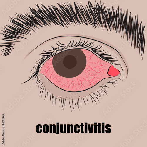 Conjunctivitis is an inflammation of the transparent membrane between the eyelid and the eyeball.