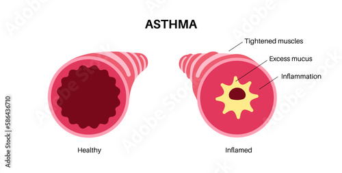 Asthma lung disease