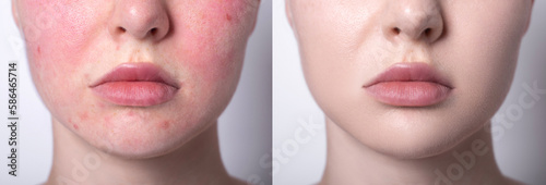 Rosacea couperose redness skin treatment, before and after result of IPL laser treatment, red spots on cheeks, young woman with sensitive skin, patient face close-up