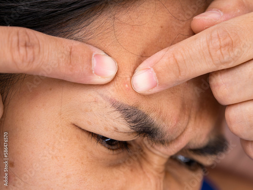 Close-up of Asian woman squeezing pimples on her face. Skincare lifestyle concept