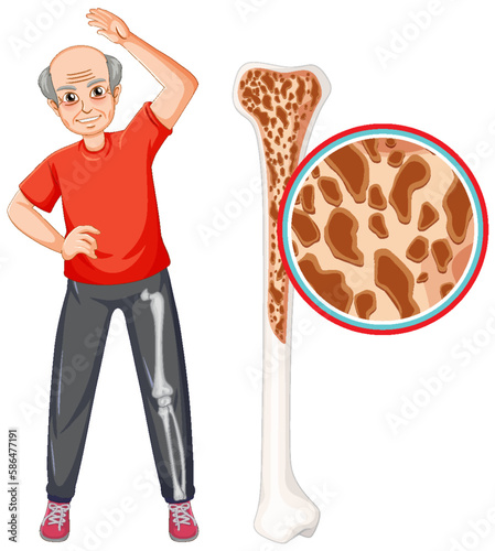 Osteoporosis in old people
