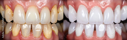 Professional teeth whitening and cleaning, before and after results. Created with Generative AI technology.
