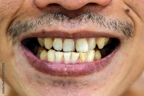 patient before prophylactic treatment, dirty brown teeth