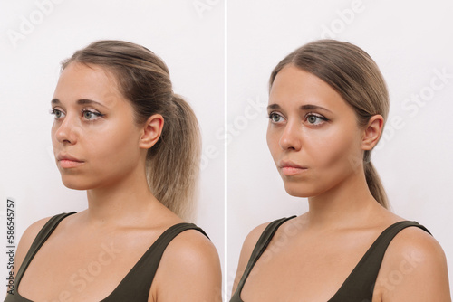 Young blonde woman's face before and after plastic surgery buccal fat pad removal isolated on a white background. A lower part of face with clear highlighted cheekbones. Result of cosmetic surgery photo