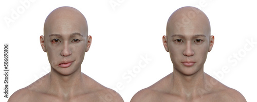 Facial palsy in a man and the same healthy man, 3D illustration showing the asymmetry and drooping of the facial muscles on one side of the face photo