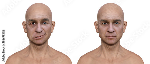 Facial palsy in a man and the same healthy man, 3D illustration showing the asymmetry and drooping of the facial muscles on one side of the face