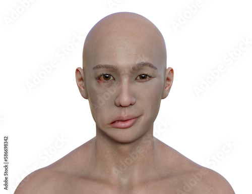 Canvas Print Facial palsy in a man, 3D illustration highlighting the asymmetry and drooping o