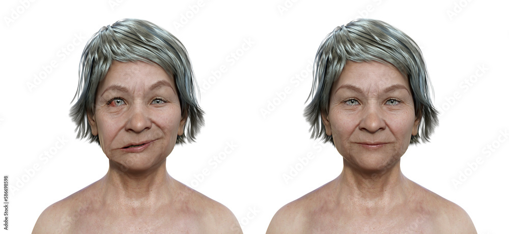 Facial palsy in a woman and the same healthy person, 3D illustration showing the asymmetry and drooping of the facial muscles on one side of the face - obrazy, fototapety, plakaty 
