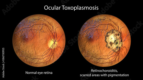Retinal scar caused by a Toxoplasma gondii infection, or toxoplasmosis, and the same healthy eye retina for comparison, 3D illustration photo