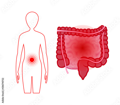 Ulcerative Colitis. Inflammatory bowel disease. Ulcer and inflammation of the digestive tract, abdominal pain. Human internal organ, anatomy, medicine concept, healthcare.