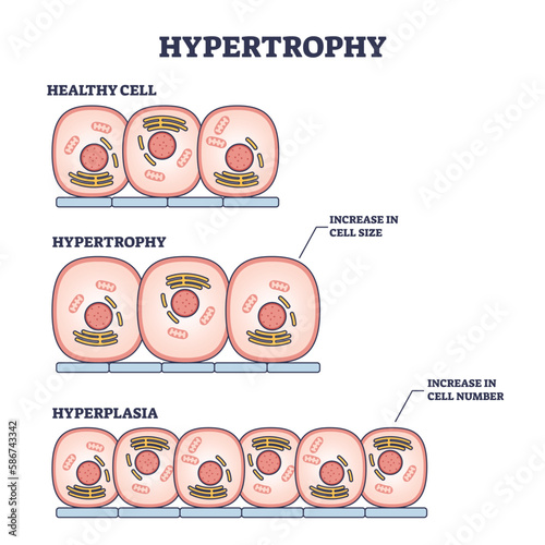 Hypertrophy, hyperplasia or healthy muscular cells comparison outline diagram. Labeled educational scheme with increased cellular fluid after weight lifting or increase amount vector illustration.