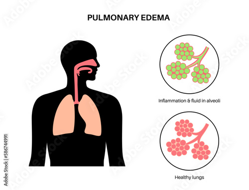 Pulmonary edema disease