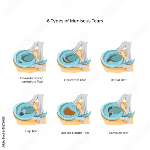 Vector illustration. 6 Types of Meniscus Tears