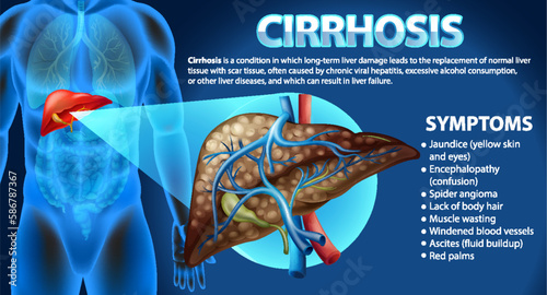 Informative poster of alcoholic liver disease Cirrhosis