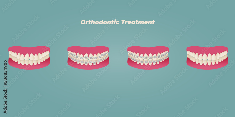 The concept of teeth alignment with braces. Orthodontic dentistry. The
