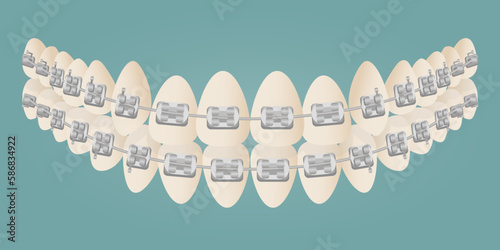 The concept of teeth alignment with braces. Orthodontic dentistry. The alignment of the teeth. Beautiful white teeth. Isolated flat vector illustration. Simple teeth in a row. Orthodontic treatment.