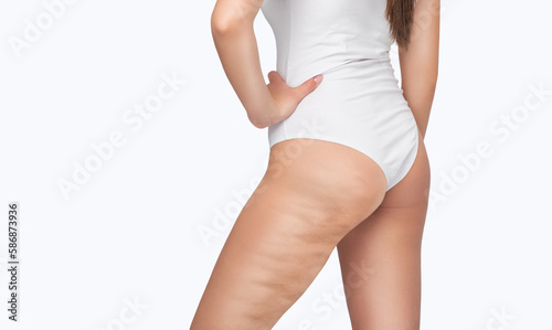 Fat woman with cellulite on her legs. Obese woman in white underwear.Overweight treatment.