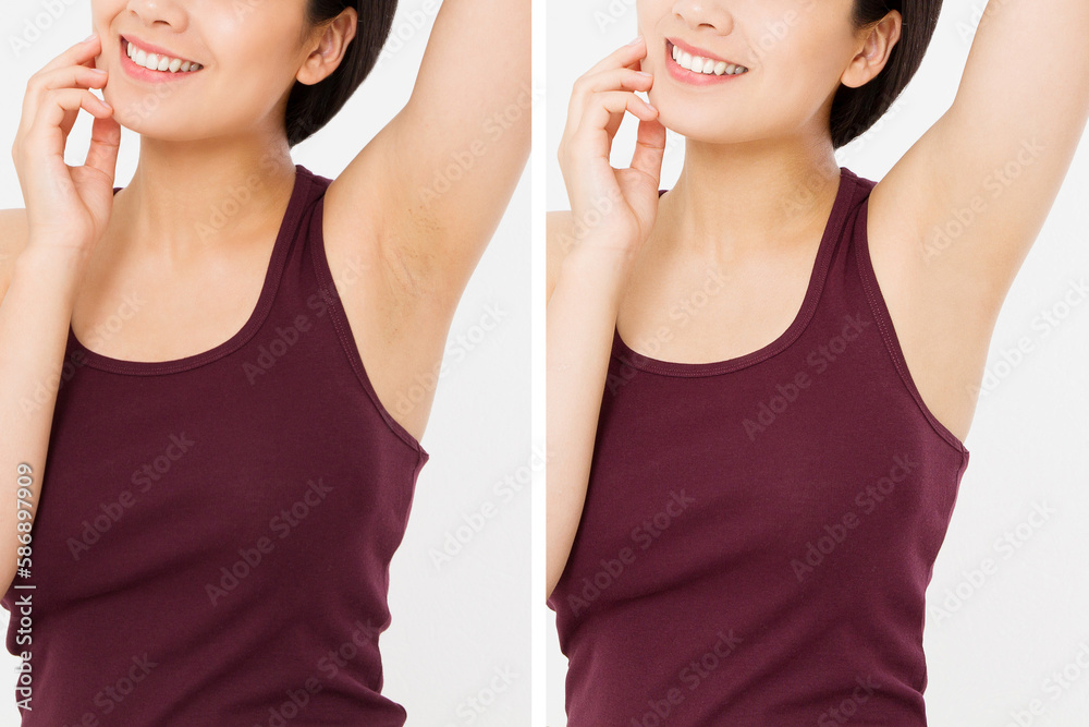 Skin care armpit before after concept. Young asian woman armpits before