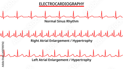 Set of ECG Common Abnormalities - Right Atrial Enlargement / Hypertrophy vs Left Atrial Enlargement / Hypertrophy - Normal Sinus Rhythm