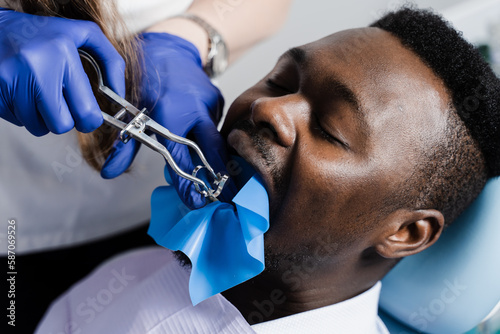 Process of installing dental cofferdam in jaw of african man for treatment teeth in stomatology. Dentist using dental dam for tooth isolation. photo