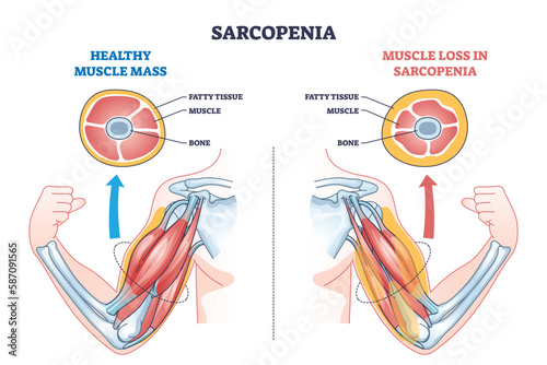 Sarcopenia as muscle mass loss and fatty tissue growth outline diagram. Labeled educational medical scheme with aging caused weakness and muscular pathology vector illustration. Obesity health issue.