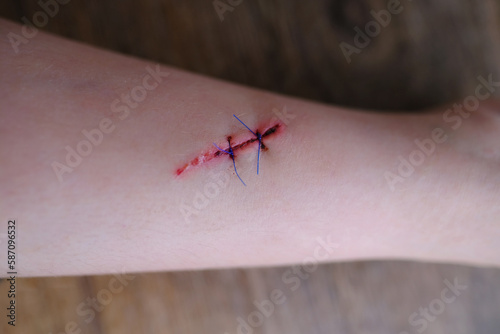 fresh wound on child's leg, non-absorbable sutures, wound care after skin procedure with sutures, trauma safety concept for children, treatment of surgical wounds, medical care, antiseptic treatment © kittyfly
