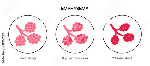 Emphysema anatomical poster