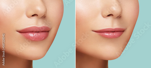 Comparison of women's lips filler correction before and after Hyaluronic acid injection. Injected and non-injected lips. Beauty lip treatment procedure. Natural lips shape. Lips Augmentation