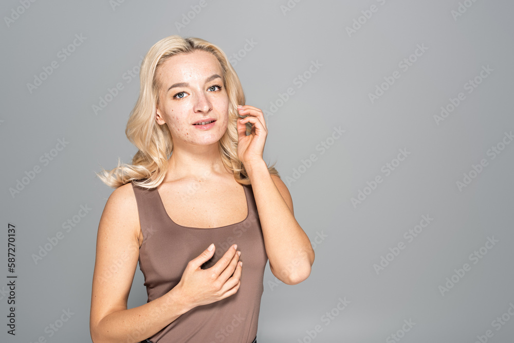 Woman with acne on skin looking at camera isolated on grey. Woman with acne on skin looking at camera isolated on grey.