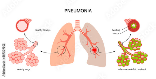 Pneumonia infection poster