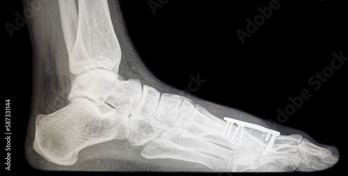 Xray image of Bone block distraction arthrodesis - MTP1 of the hallux metatarsophalangeal joint after resection arthroplasty. female foot after surgery - standing position with minimal load, pressure photo