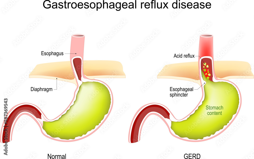 Gastroesophageal reflux disease. GERD. Cross section of human stomach ...