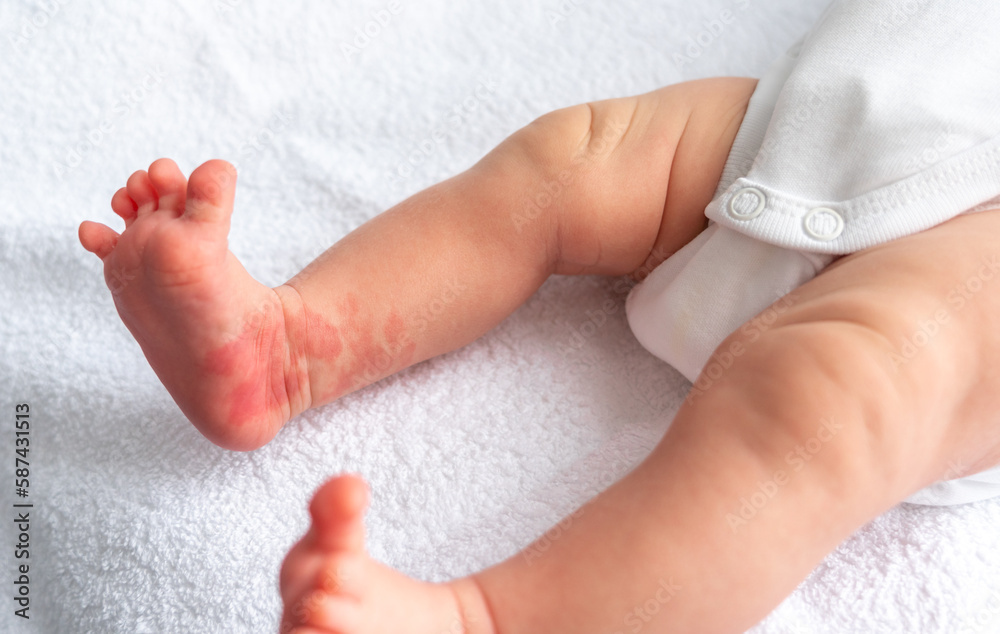 Hemangioma red birthmark on the leg of newborn baby Hemangioma red birthmark on the leg of newborn baby