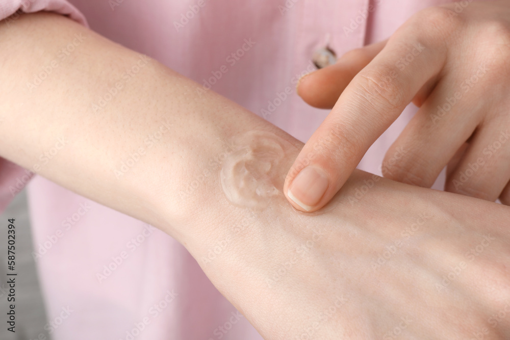 Woman applying ointment on her hand, closeup Woman applying ointment on her hand, closeup