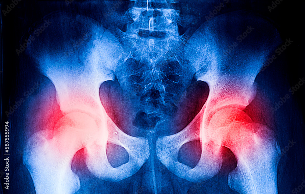 Severe pain in the cartilage joints, femoral head. Pelvis, degenerative