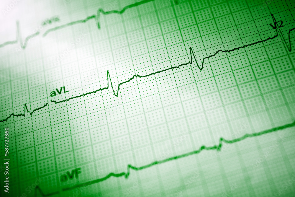 Close-up of an electrocardiogram printed on green paper. Close-up of an electrocardiogram printed on green paper.